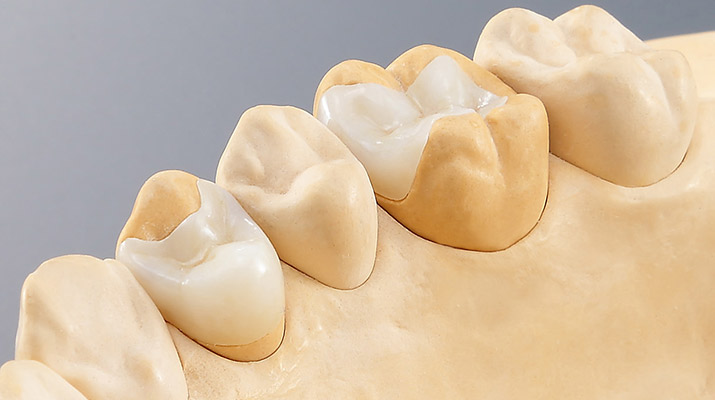 DWX-51D dental inlay onlay